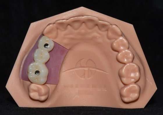 Implantat Porselein gesmolten met Zirconia Implantat Kroonbrug