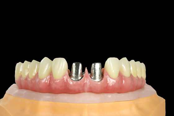kopen FDA Titanium brug tandheelkundige implantat Titanium frame met kroon online manufacture