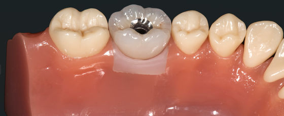 kopen Hoogest esthetische edelmetaal kroonimplantat kroonbrug metaallegeringen online manufacture