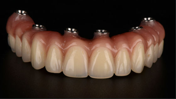 kopen All On X Implantat ondersteunde tandheelkunde Titanium brug tandheelkundige CE FDA goedkeuring online manufacture