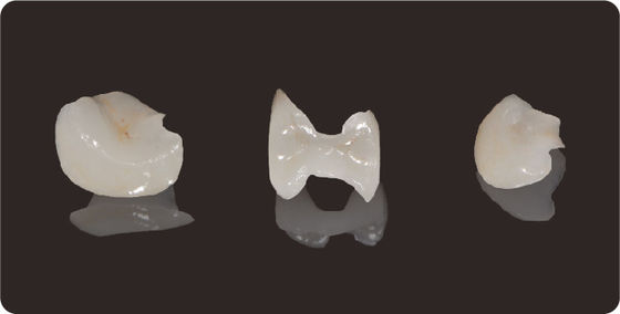 kopen Precision Dental Inlays And Onlays Lithium Disilicaat Fressing Onlay Veneer online manufacture