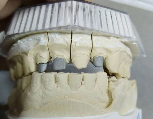 kopen Post Core Niet-edelmetalen kroon en brug Sterke sterkte Aanpasbaar online manufacture