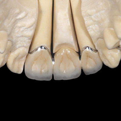 kopen Niet-edel PFM kroonimplantat porselein gesmolten met metalen kroon online manufacture