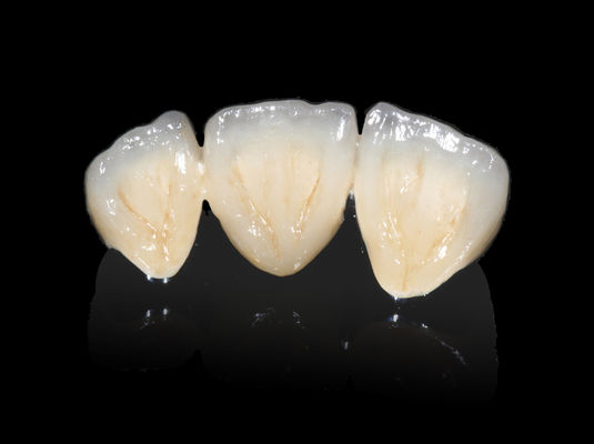 kopen Implantaten Tandheelkundige PFM-brug Niet-prijswaardige CAD CAM PFM-kroon online manufacture