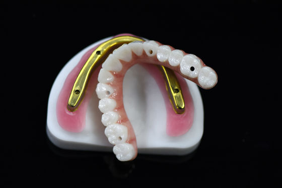 kopen Aanpasbare tandheelkundige zirconia brug over gefreesde implantaatbalk online manufacture