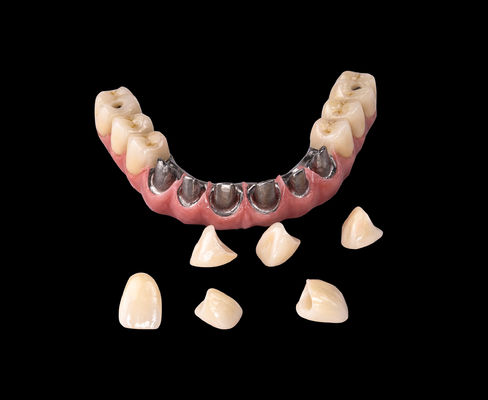 kopen Alle op X Implantat Titanium brug Tandheelkundige alleen kader Professionele online manufacture