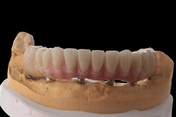 kopen Hybride tandheelkundige implantaten Hybride tandheelkundige prothese met titanium bar online manufacture