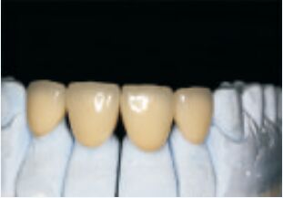 kopen Witte, hoognobele, edel legering, kroon en brug, accuraat en op maat. online manufacture