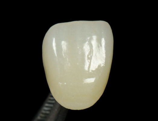 Aanpasbare Emax Press Crown Fast And High Esthetics Tandheelkundige Inlay Onlay