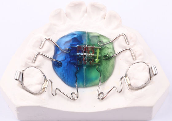 FDA Pendulum Appliance Orthodontie Pendulum Ortho Appliance Aanpasbaar