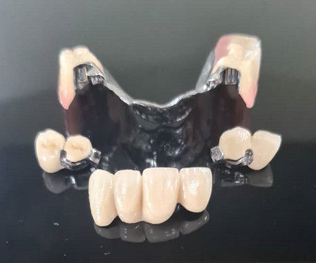 Metalen frame Precision Attachment Overdenture Afneembare tandprothese