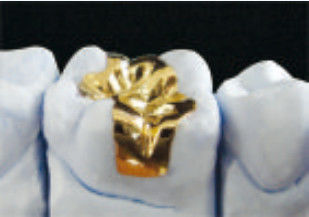 Fit Excellent Dental Gold Onlay CE en FDA Gold Inlays en Onlays