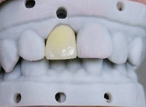 Hoge esthetiek Composite Crown Onlay Veneer Aanpasbare grootte
