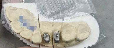 Metalen / natuurlijke Ti basis kroon post kern titanium kroon voor tanden