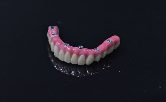 Implantatie van tandheelkundige prothesen voor onmiddellijke belasting Lichte roze verwijderbare kunsttanden