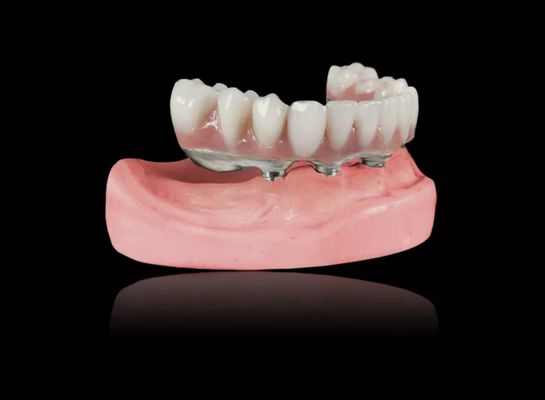 Implantaten Titaniumbalk Afneembare gebit Titanium legering Implantatenbalk Overprothese