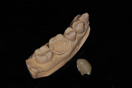Dental Composite Onlay Veneer High Aesthetics Composite Veneer